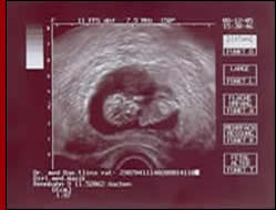 Ultraschall-Bild, 12. Woche